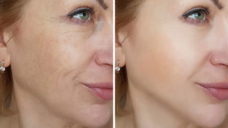 Pelleve Skin Tightening, Before & After Photos